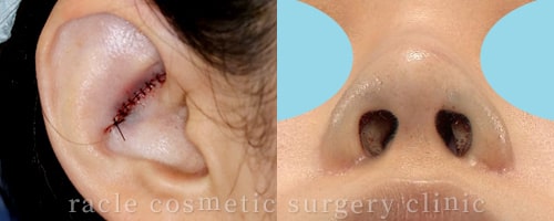 鼻孔縁下降術の術後の耳の傷 イメージ